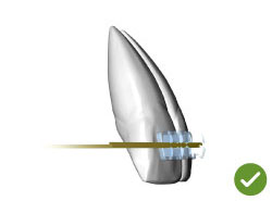 incisivi-arco-bidimensionale-dynforce1