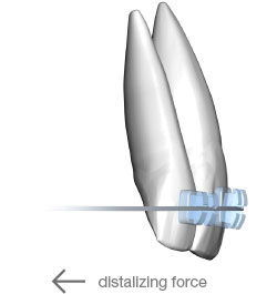 Dynforce bidimensional archwire