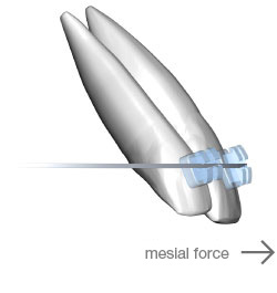 Dynforce bidimensional archwire