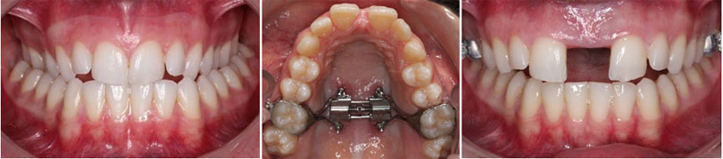 Non-surgical Mid-facial Expansion with Micro-implant Assisted